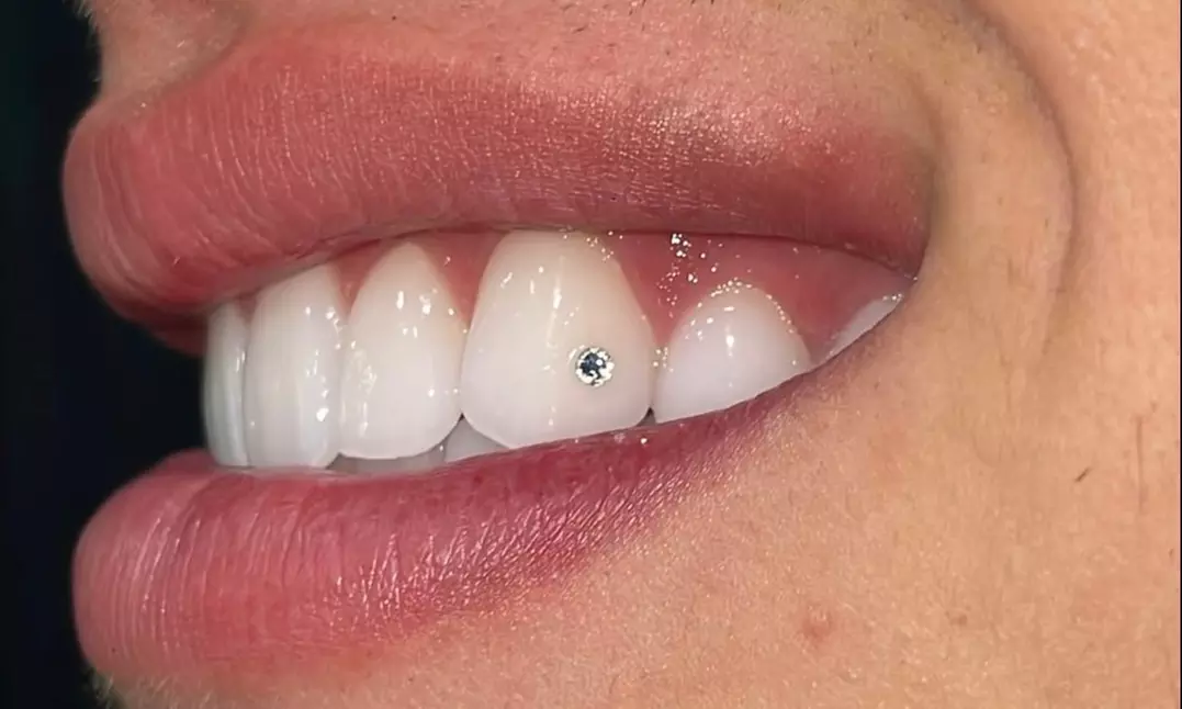 Brighten Your Smile with Tooth Gems