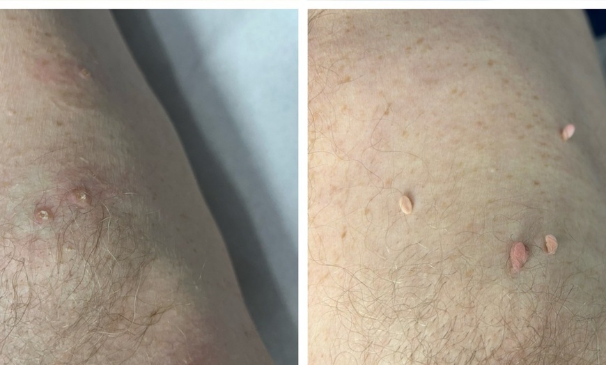 Image 8: Up to Unlimited Skin Tags, Milia, Blood Spot or Mole Wart Removal