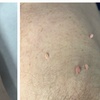 Image 8: Up to Unlimited Skin Tags, Milia, Blood Spot or Mole Wart Removal