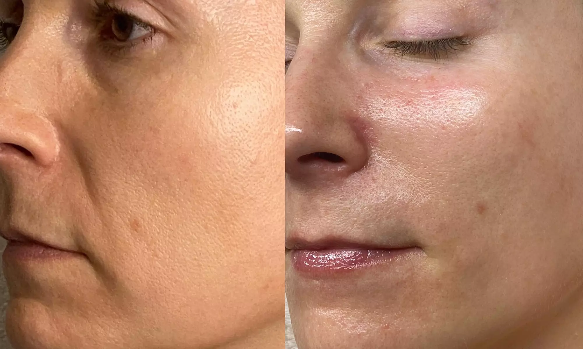 Infrared 1319 nm Laser Glow: Lift, Tighten & Renew