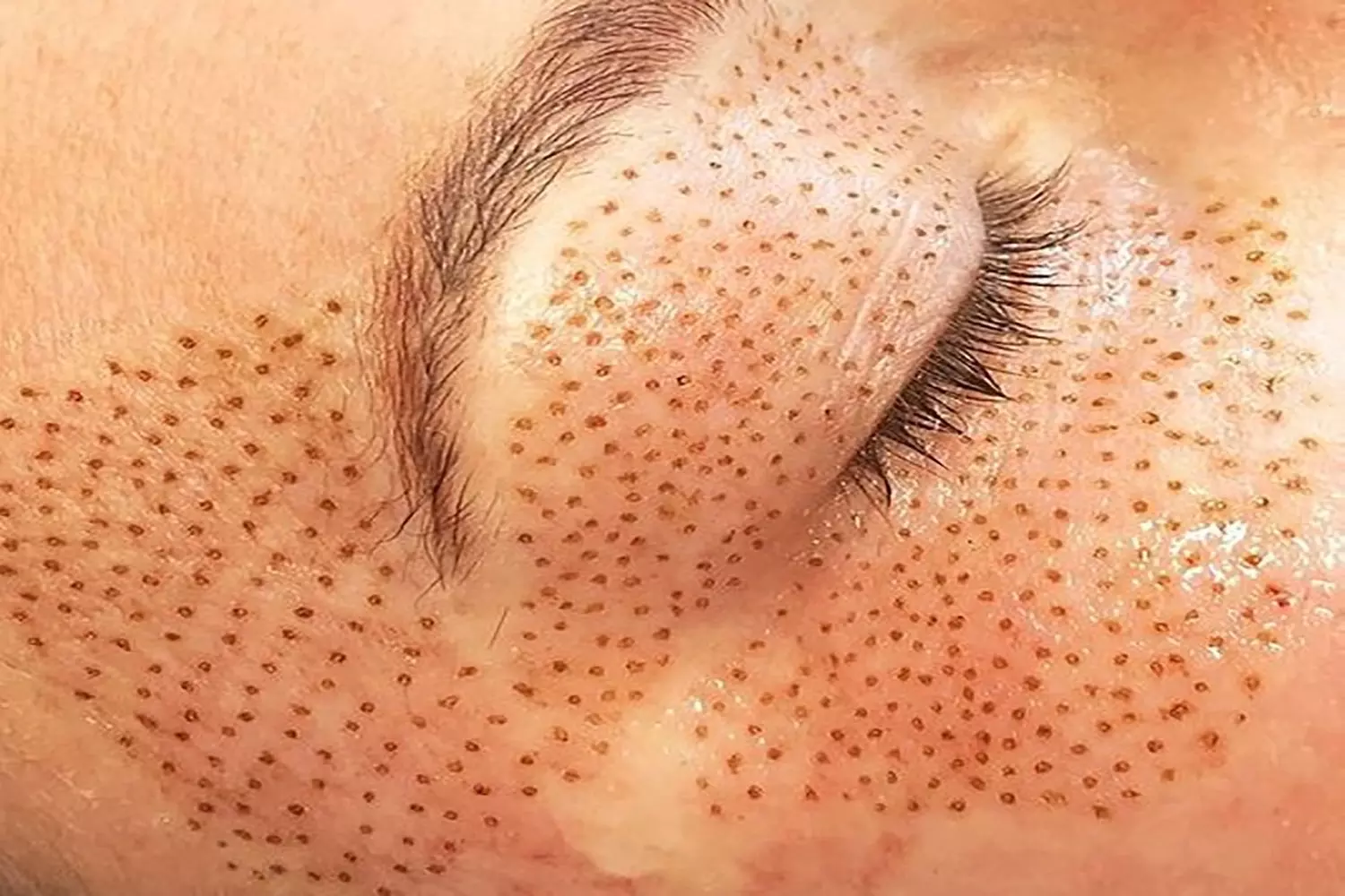 Up to 31% Off on Facelift - Non-Surgical at Aesthetics Care Med Spa