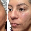 Image 1: One or Three Sessions – EZ GEL PRF for Under Eyes