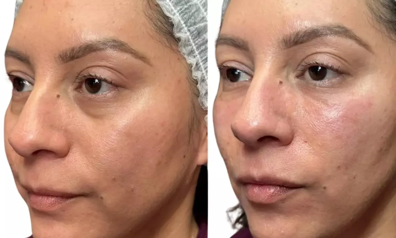 One or Three Sessions – EZ GEL PRF for Under Eyes