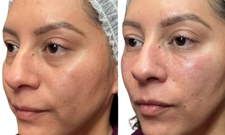 One Session – EZ GEL PRF for Under Eyes - SKIN & EYES MedSpa