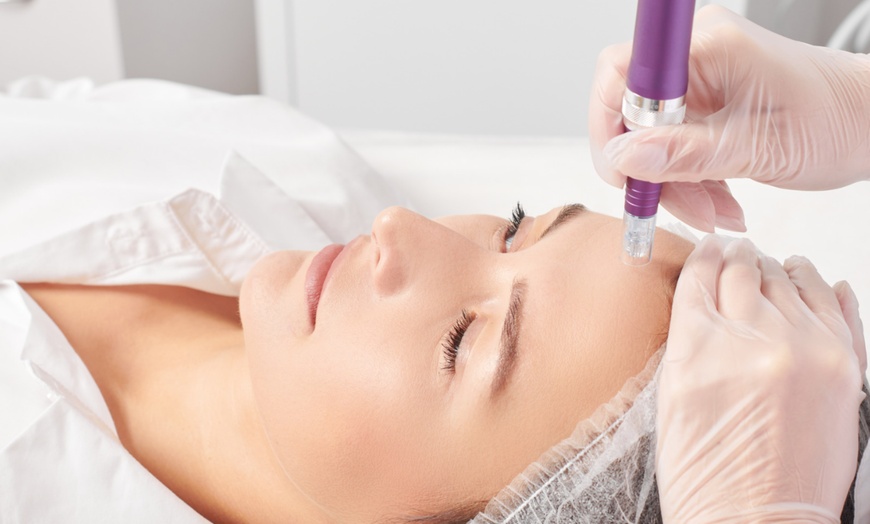 Image 1: Skin-Needling Face and Neck Refresh – One, Two or Three Sessions
