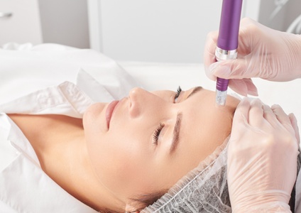 Three Sessions of Skin-Needling Face and Neck Refresh Treatment - Organik Laser & Beauty