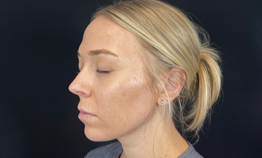 Image 2: Unleash Radiance:Transform Your Skin w/1 or 3 Laser Resurfacing Magic!