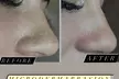 Up to 35% Off on Facial at Ursula Versace Aesthetics - Second Medium