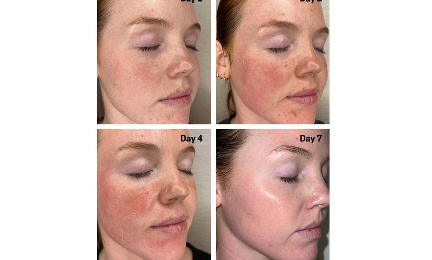 Image 1: Up to 73% Off on Facial - Chemical Peel at bc clinic