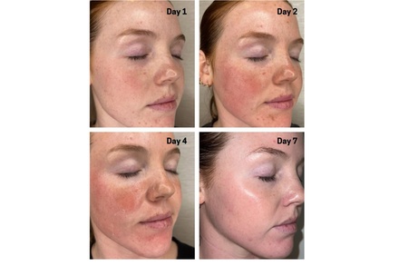 One Session Chemical Peel, Facial Cleansing - bc clinic