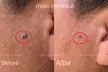 Removal of up to 3, 5, or 10 Skin Tags, Cherry Angiomas, Age Spots or Milia for 2mm Size (Up to 90% Off) - Second Medium