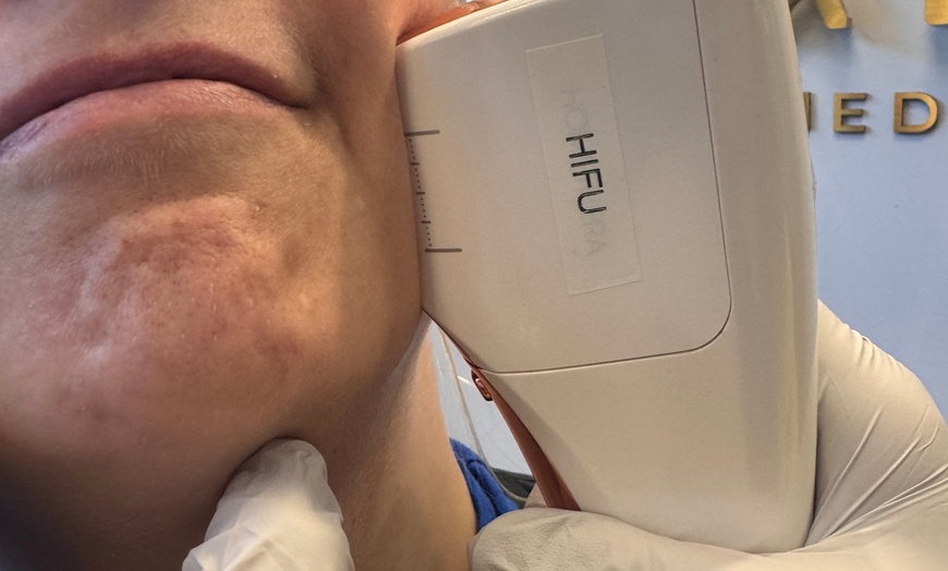Image 1: HIFU Non-Invasive Lifting, Skin Tightening of Skin, Jawline and Cheeks