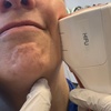 Image 1: HIFU Non-Invasive Lifting, Skin Tightening of Skin, Jawline and Cheeks