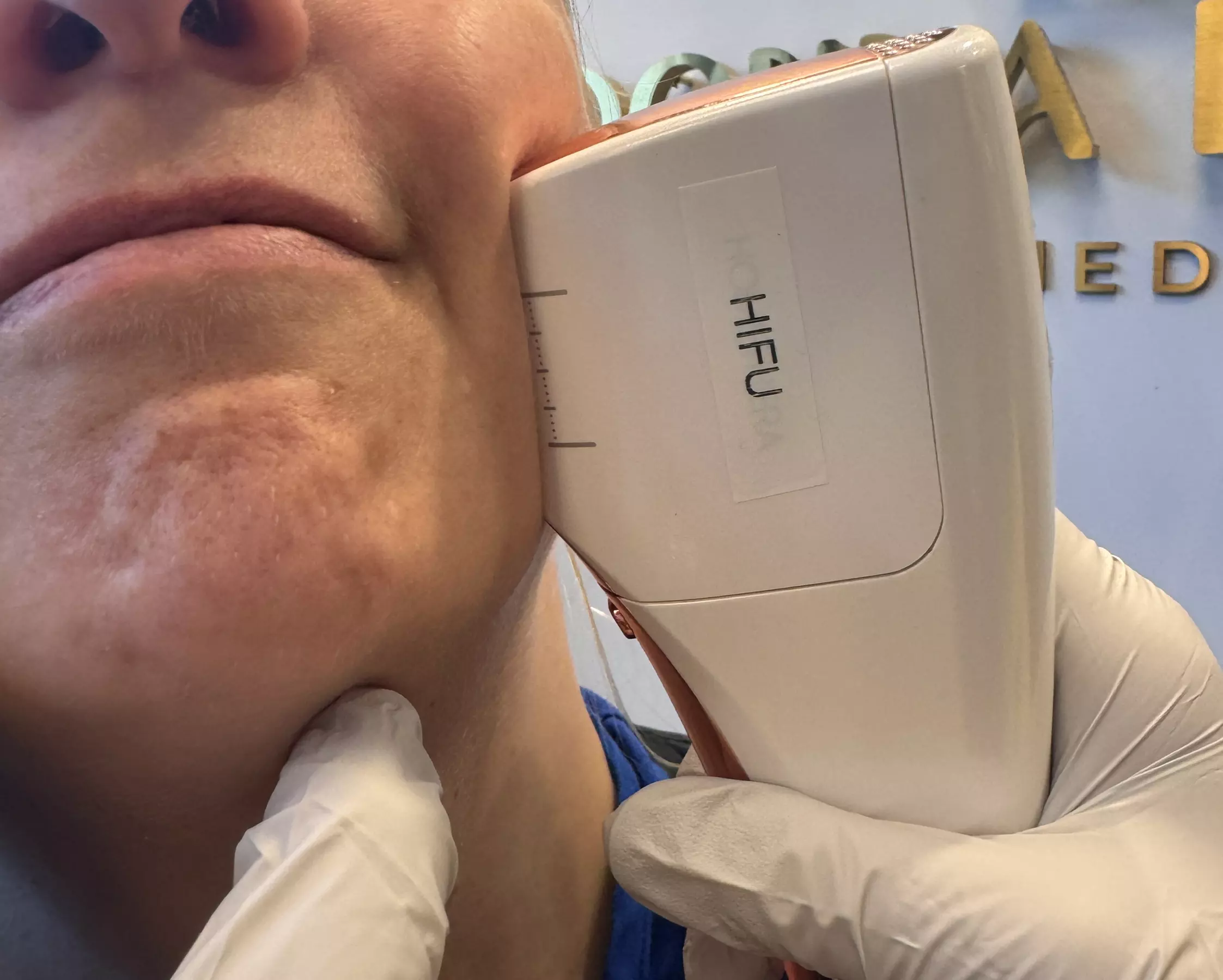 HIFU Non-Invasive Lifting, Skin Tightening of Skin, Jawline and Cheeks