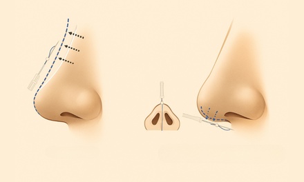 Non-surgical rhinoplasty. PDO threads. - Antonoff Aesthetic