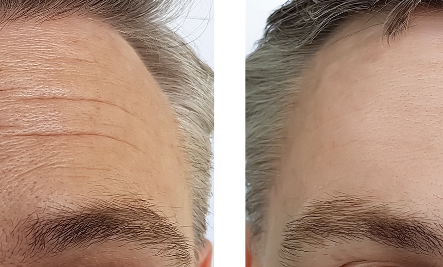 Image 5: Refresh with 20 or 40 Units of Botox