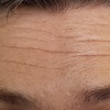 Image 5: Refresh with 20 or 40 Units of Botox