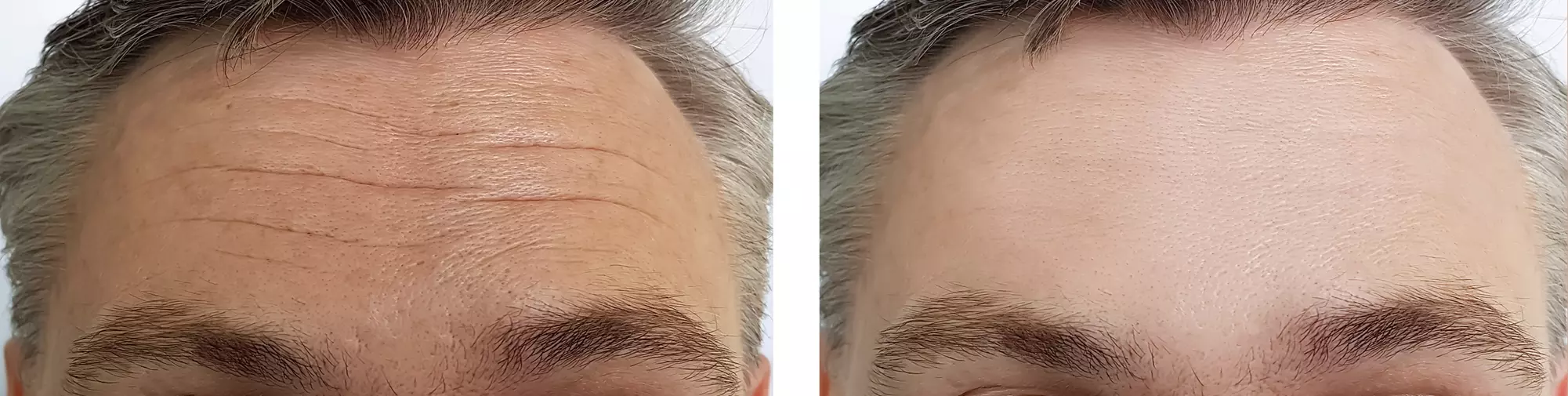 Refresh with 20 or 40 Units of Botox