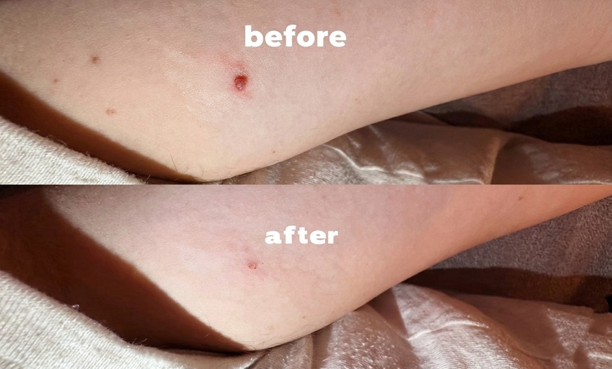 Image 2: Removal of 1, 5, or 10 Skin Tags, Cherry Angiomas, Age Spots, or Warts