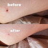 Image 2: Removal of 1, 5, or 10 Skin Tags, Cherry Angiomas, Age Spots, or Warts