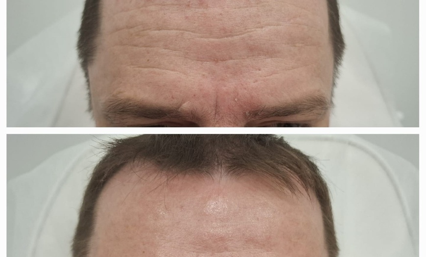 Image 5: Do 56% zniżki na Zastrzyk - Botox w Richter Clinic Iwona Richter