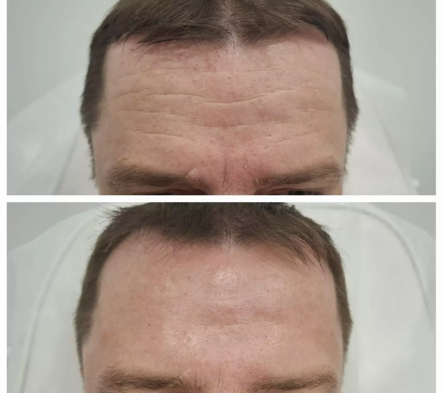 Do 56% zniżki na Zastrzyk - Botox w Richter Clinic Iwona Richter