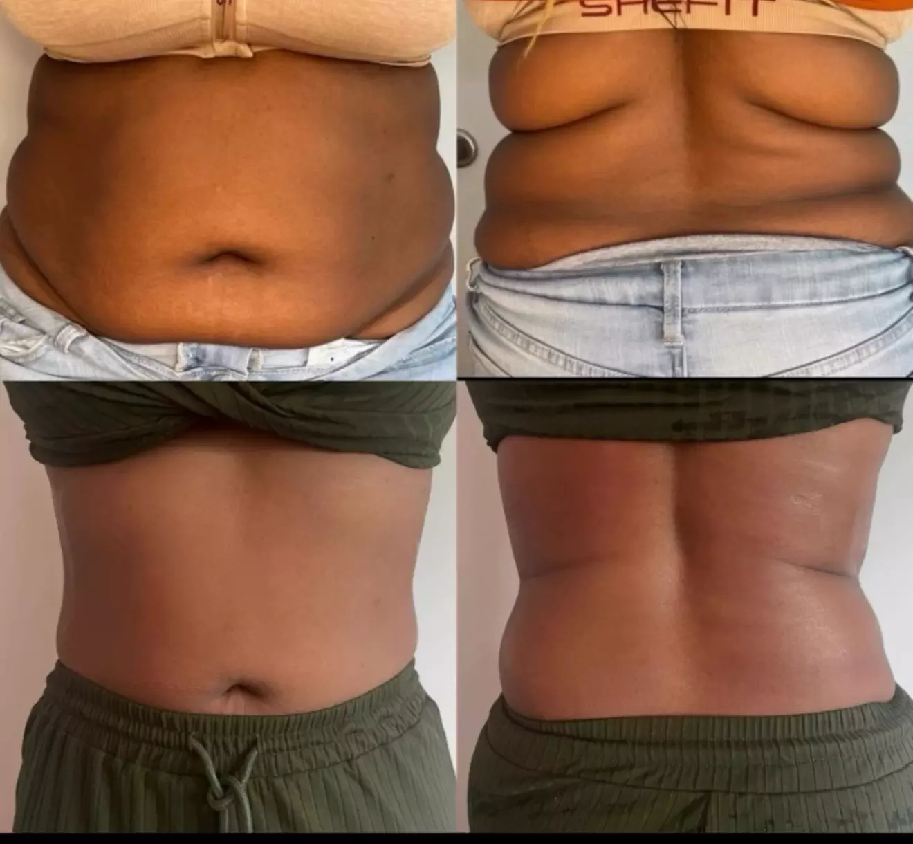 Non-Surgical Solution: Fix Stubborn Fat with Lipo Sculpt Lite