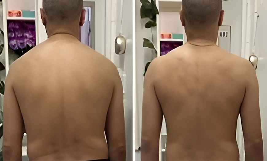 Image 3: Acupuncture, Electroacupuncture at Aquarius Beauty Spa - Up to 58% Off