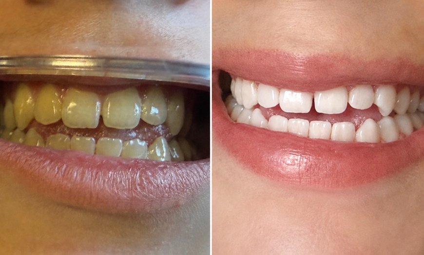 Image 2: Professional LED Teeth Whitening & Optional Full Body Spray Tan