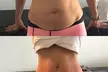 Non-Surgical Solution: Fix Stubborn Fat with Lipo Sculpt Lite - Second Medium
