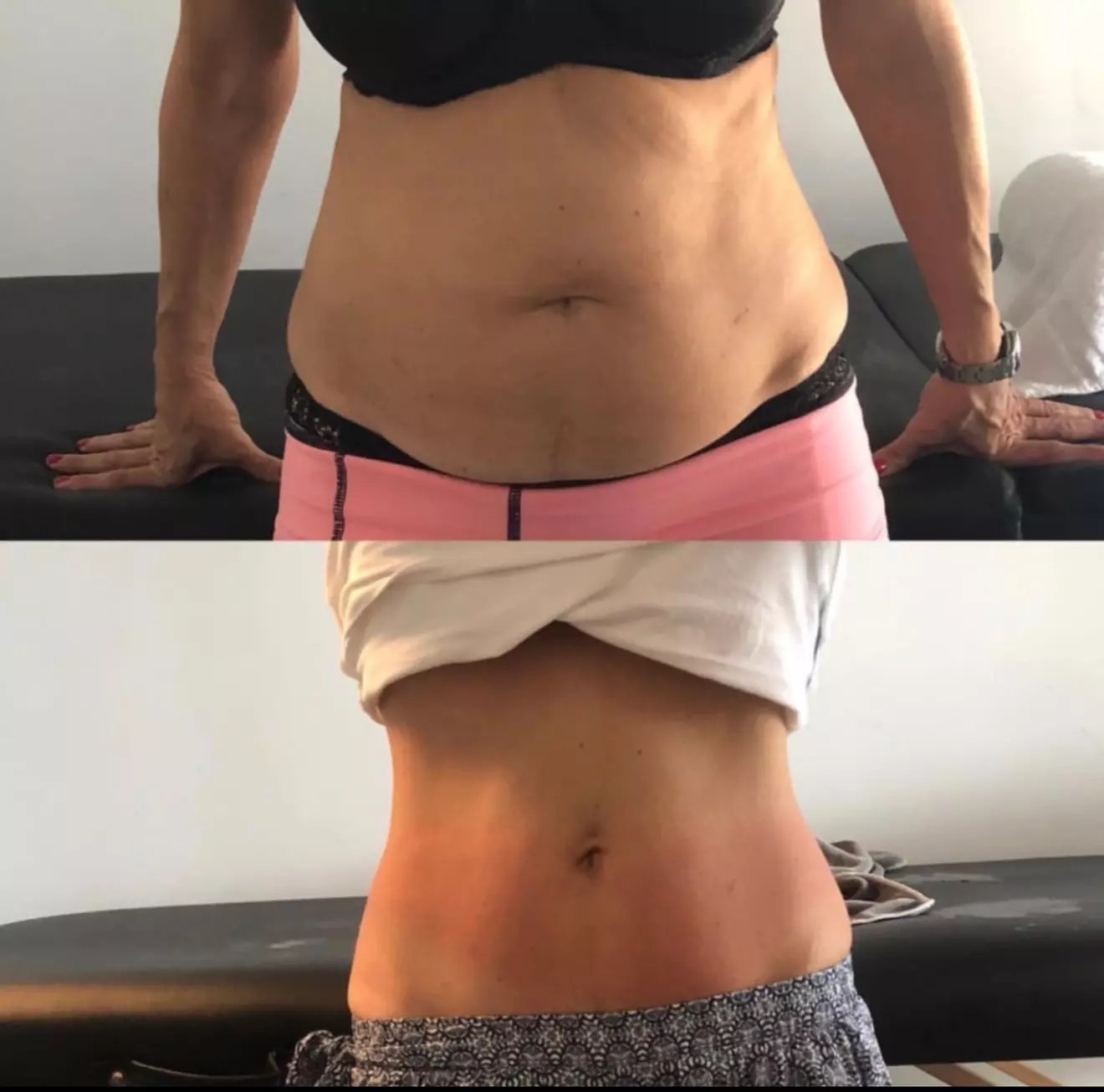 Non-Surgical Solution: Fix Stubborn Fat with Lipo Sculpt Lite