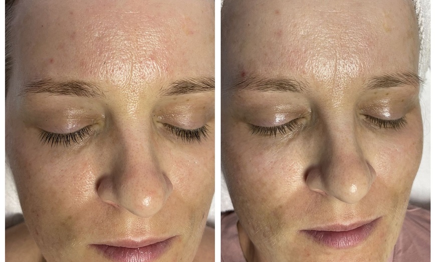 Image 3: Bis zu 50% Rabatt auf Gesichtsbehandlung - Peeling bei