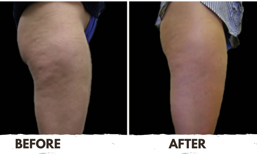 Image 7: Three, Six or Nine Sessions of VelaShape