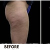 Image 7: Three, Six or Nine Sessions of VelaShape