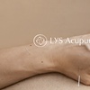 Image 9: 90-Minute Initial Acupuncture or Acupuncture & Cupping Session