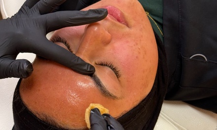 VI Chemical Peel - Skin Society Medical Spa