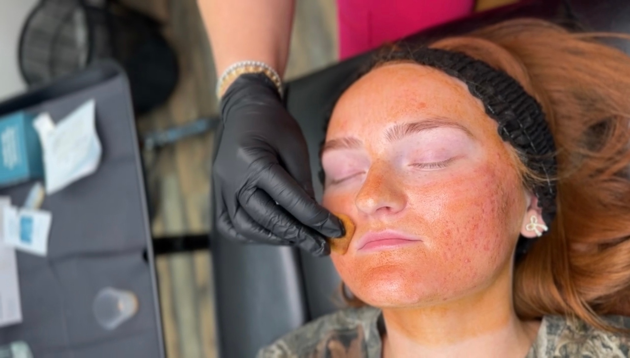 Transform Your Skin with VI Peel Treatment