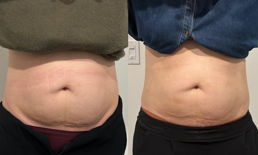 Image 4: Up to 57% Off on Ultrasonic Fat Reduction at ILLUME Skin Spa