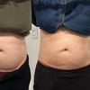 Image 4: Up to 61% Off on Ultrasonic Fat Reduction at ILLUME Skin Spa