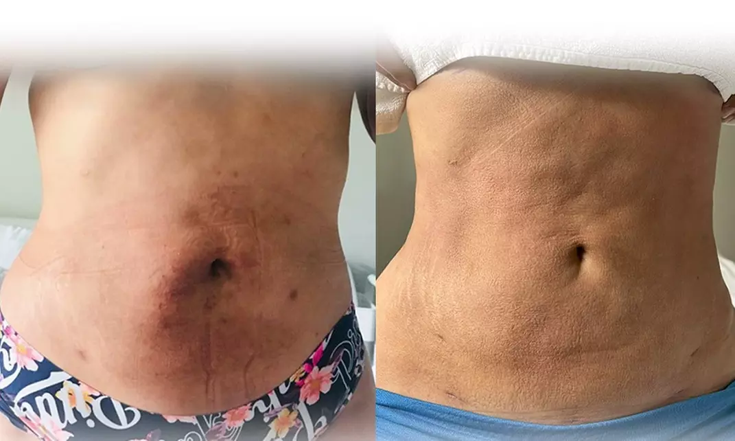 Unwind with 90-Minute Lymphatic Drainage, Reducing or Post-OP Massage