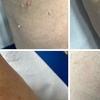 Image 4: Up to Unlimited Skin Tags, Milia, Blood Spot or Mole Wart Removal