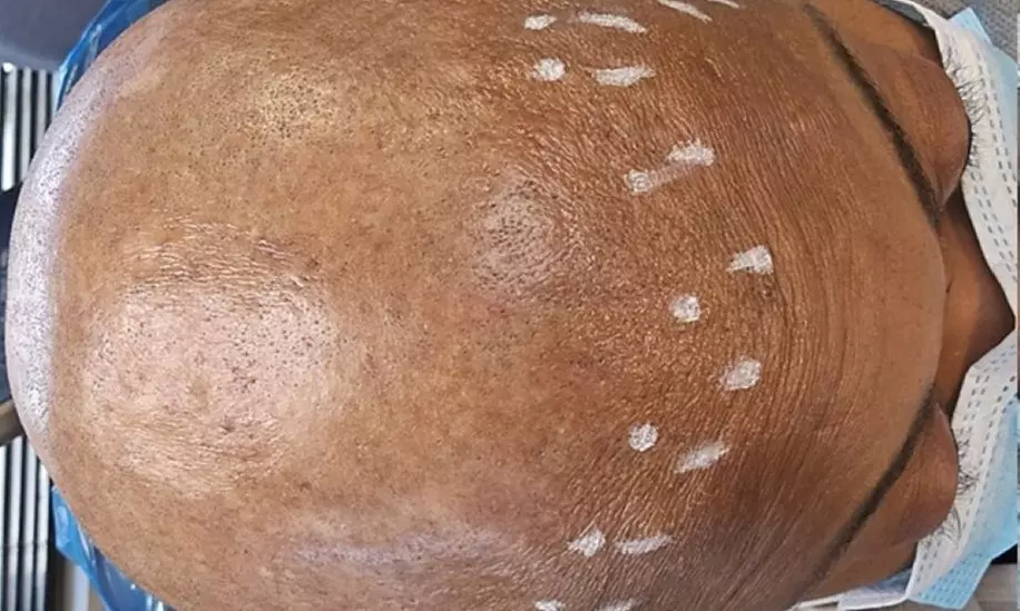 Scalp Micropigmentation for Specific or Partial Area or Full Head at HerCrown SMP Studio (Up to 44% Off) - Primary Image