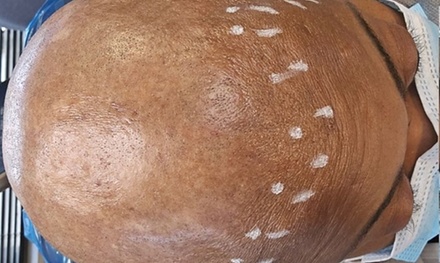 Scalp Micropigmentation Hair-Loss Treatment for Specific Area - HerCrown SMP Studio