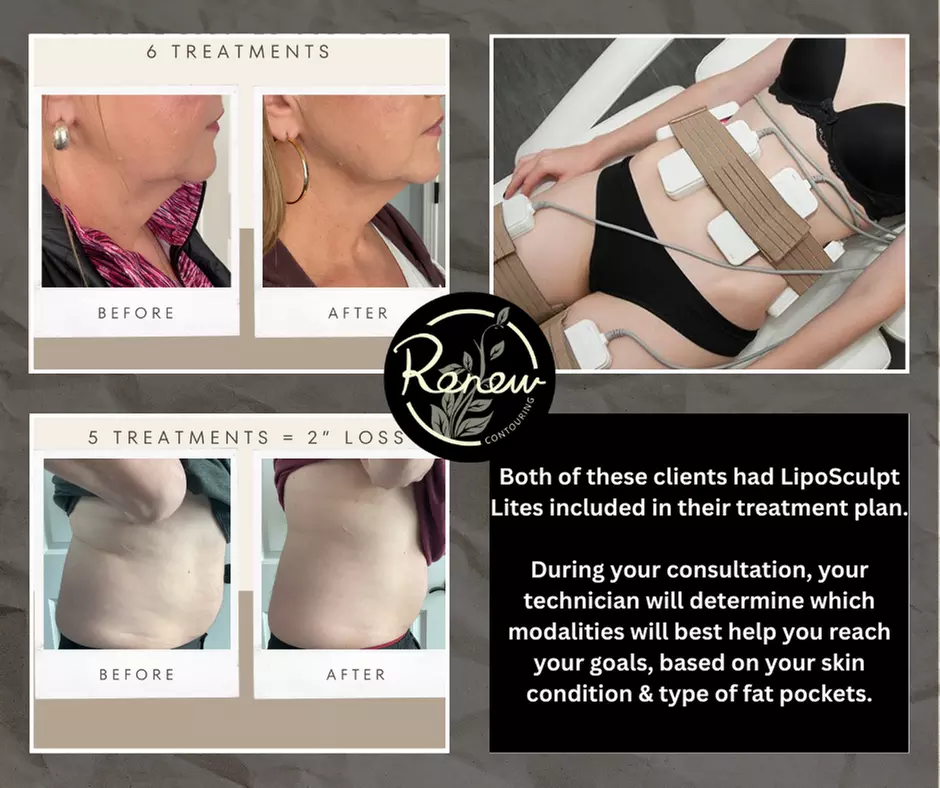 Choose from Two, Four, or Six Lipo Sculpt Lite Sessions