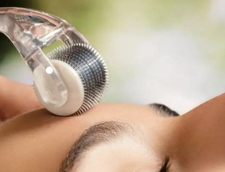 IPL, Carbon Laser, RF Lifting or Micro-needling Facial Sessions