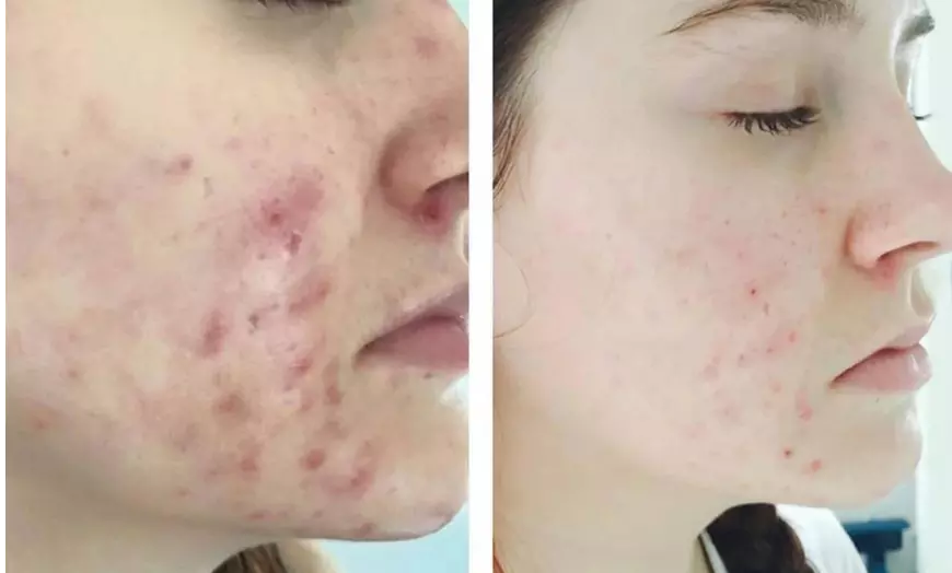 Image 4:  40 or 60-Min Dermabrasion + LED Serum with Optional Shoulder Massage