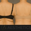 Image 2: Melt Stubborn fat with One or Two Vials of Kybella @ Clinical Care 365