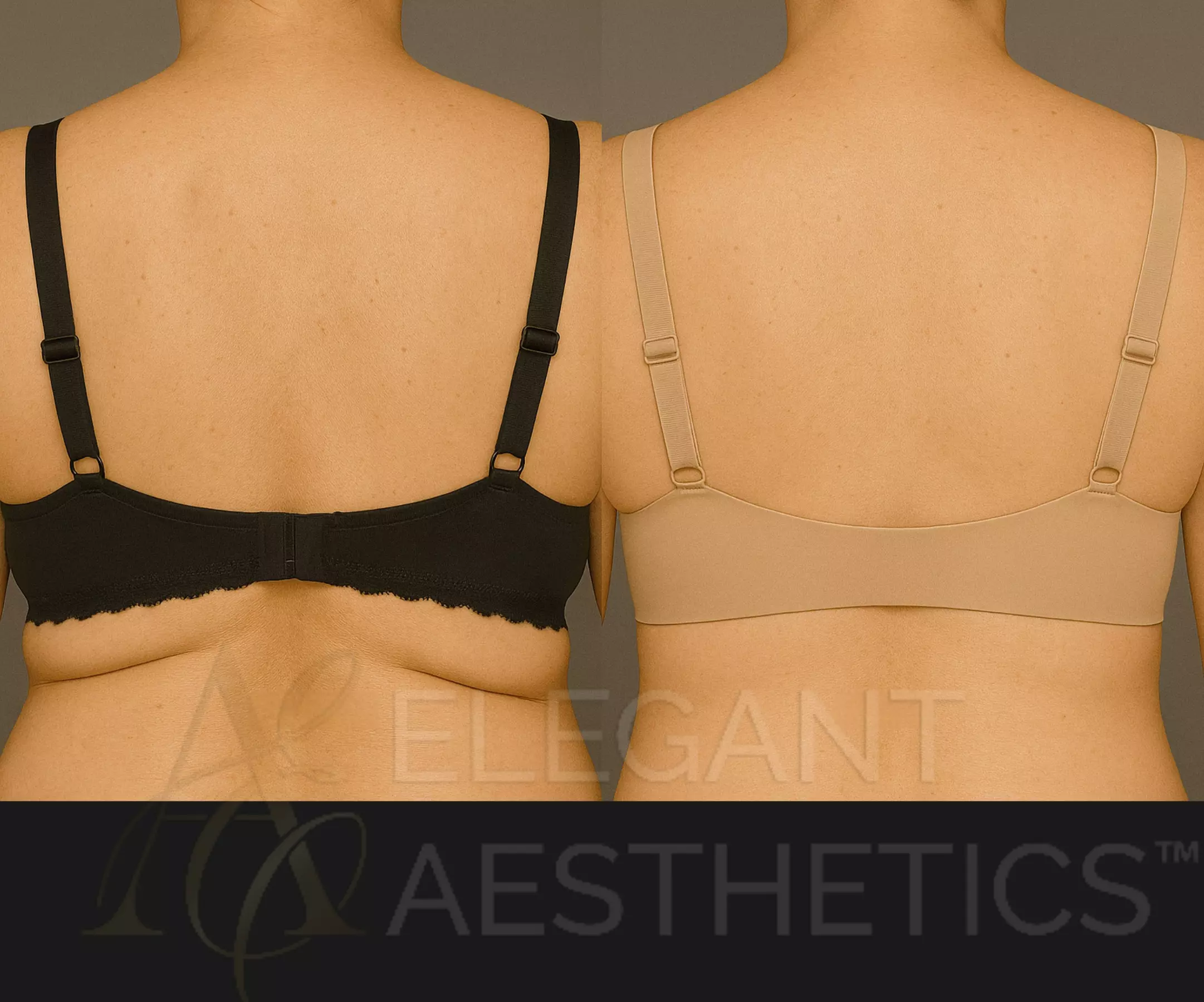 Enhance Your Look with One or Two Vials of Kybella