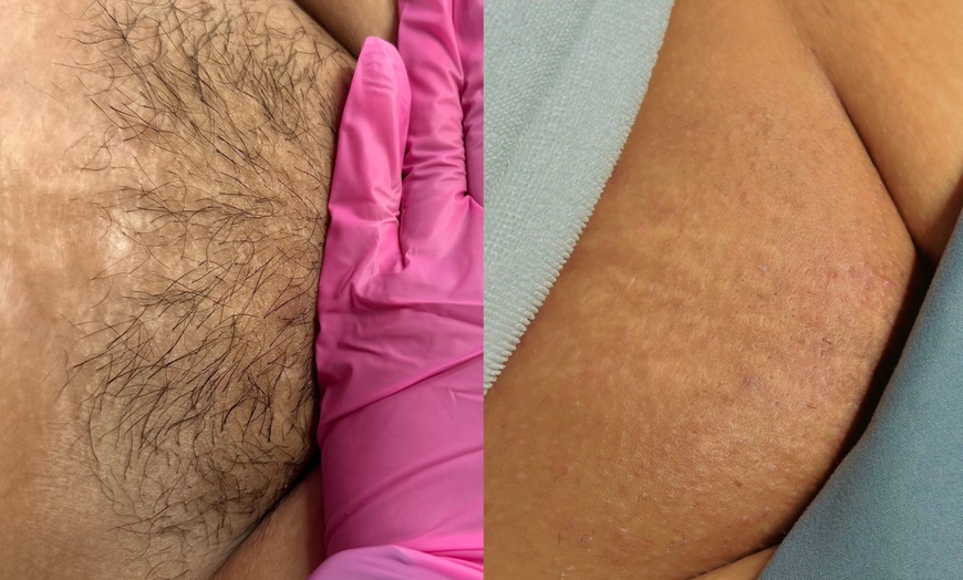 Image 5: One, Three, Five, or Ten 30-Minute Brazilian/Bikini Waxing Sessions 