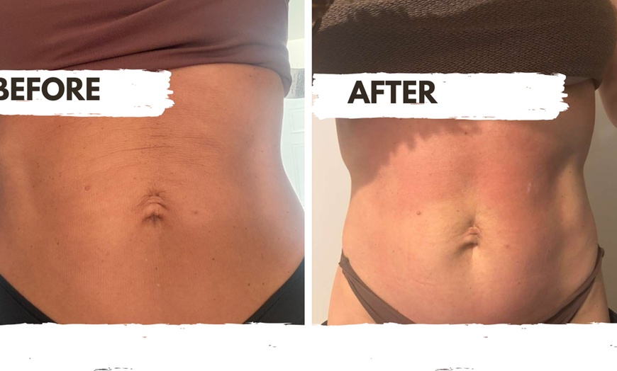 Image 5: Three, Six or Nine Sessions of VelaShape